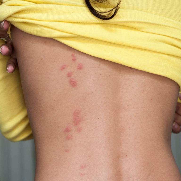 Bed Bugs - Bites grouped down a girls back Bed Bugs - Bites grouped down a girls back